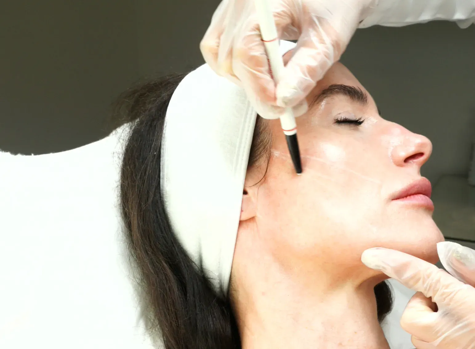 Dr Kubicka in gloves applies skin pen to woman's face during treatment at Clinicbe, natural lift procedure