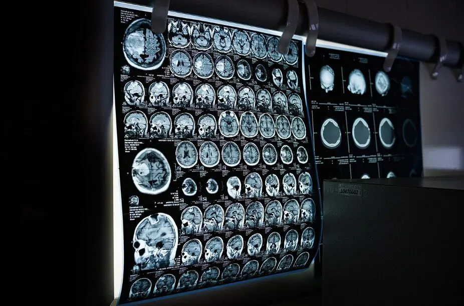 Multiple brain CT scan X-rays illuminated on a hospital lightbox viewer.